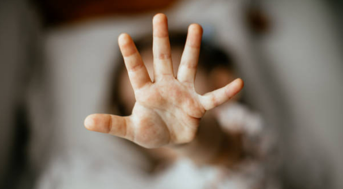 Child erroneously given HIV treatment battles brain damage