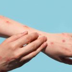 Three new mpox cases identified, all from the same Gauteng municipality