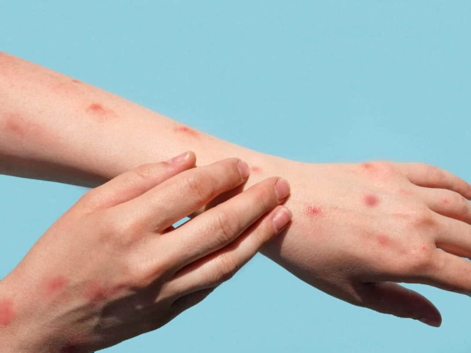 Three new mpox cases identified, all from the same Gauteng municipality