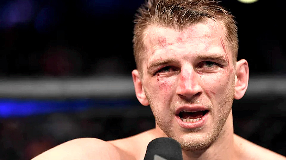 Dan Hooker posts graphic video of hand cast being removed